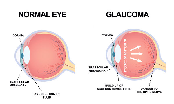 glaucoma is a common eye condition in mississauga